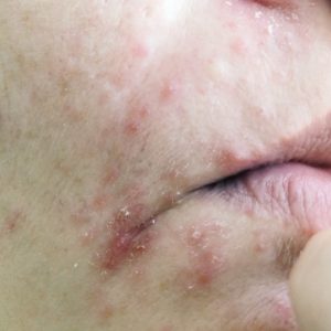 Eczema On The Face T20 Znv82w.jpg